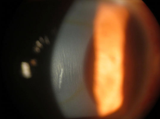 Transplante lamelar anterior