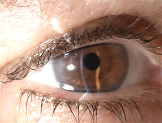 Transplante lamelar posterior ou transplante endotelial